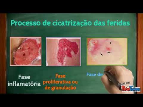 Vídeo: Diferença Entre Epitelização E Granulação