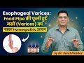 Esophageal Varices: Sure Homeopathic Treatment for Varices in the Food Pipe | Dr Patidar #esophageal