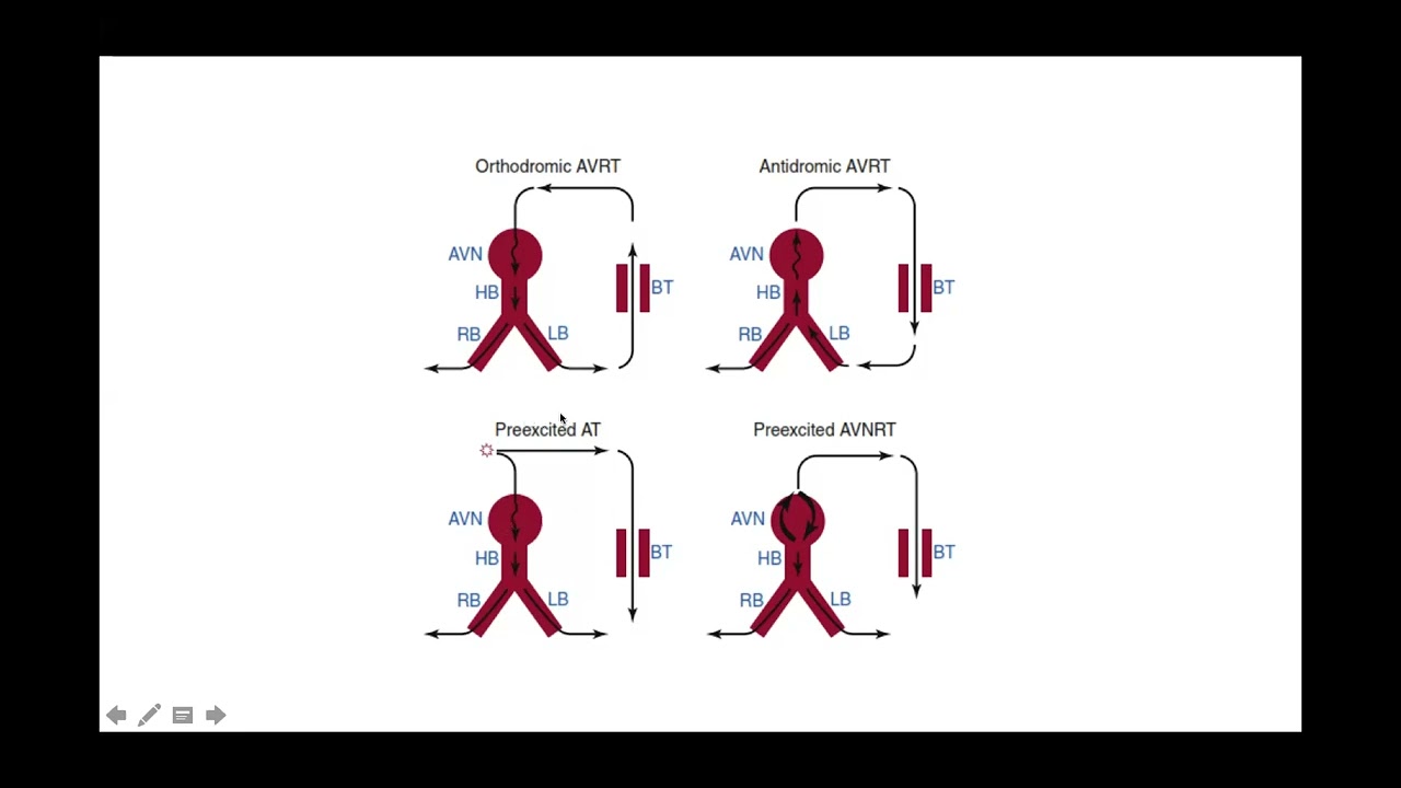 Rythmoprat les TSV chez le Nné , NRS et l'enfant Dr Wafa Boudjelida Cardiologue Rythmologe