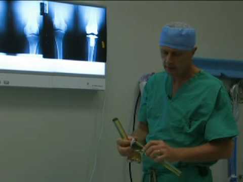 Knee Replacement Surgery at Rex