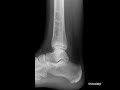 Non Ossifying Fibroma(Case findings)