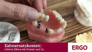 Implantat oder Brücke - Was ist wann sinnvoll? | NDR