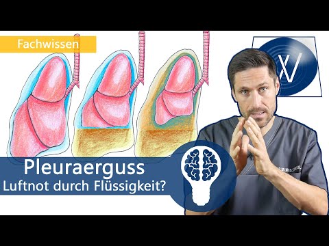 Video: Flüssigkeit In Der Brust (Pleuraerguss)