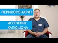 Перикоронарит. Специалист ЦМСиН об иссечении капюшона зуба мудрости