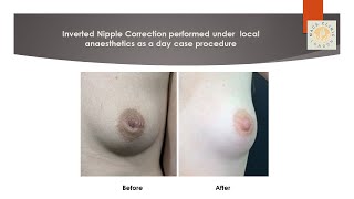 Inverted Nipple Correction performed under local anaesthetics at MACS Clinic