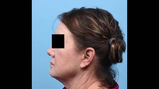 Lower Face and Neck Lift (Austin, TX)