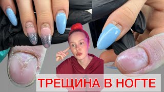 ТРЕЩИНА В НОГТЕ | ЧТО ДЕЛАТЬ ЕСЛИ ТРЕСНУЛ НОГОТЬ? ТРЕЩИНА НА НОГТЕ | КАНАЛООБРАЗНАЯ ДИСТРОФИЯ