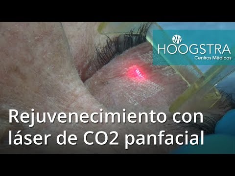eyelid surgery Rejuvenecimiento con láser de CO2 panfacial (17045)
