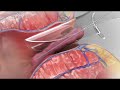 Treatment of Piles with Laser - Dr. Harsh Garg | Laparoscopic Surgeon in Chandigarh +91-9878864926