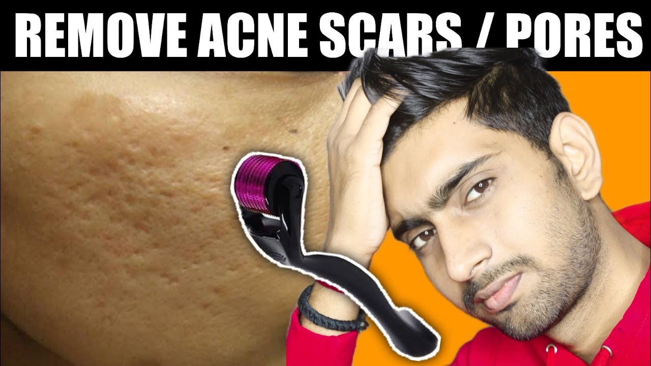 how-to-remove-small-big-pores-from-face-naturally-5-natural-hacks
