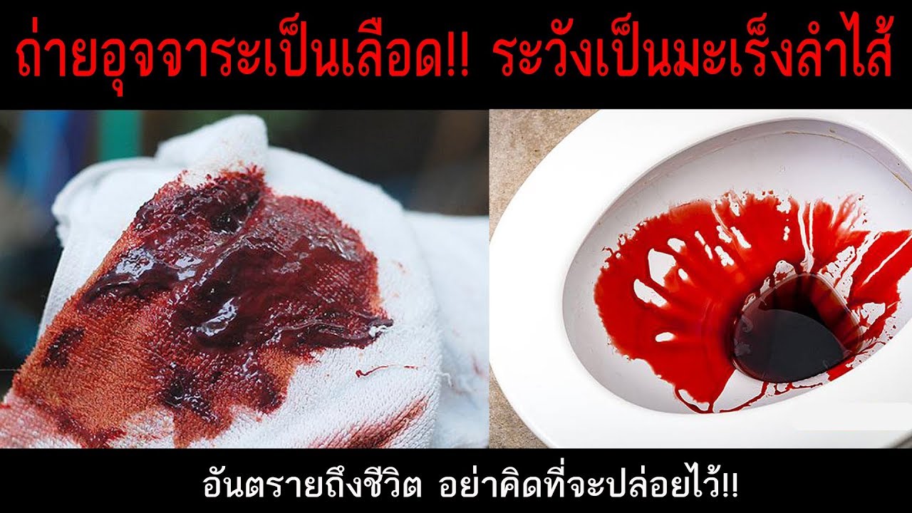 ถ่าย แข็ง เป็น เลือด ซับ ไทย