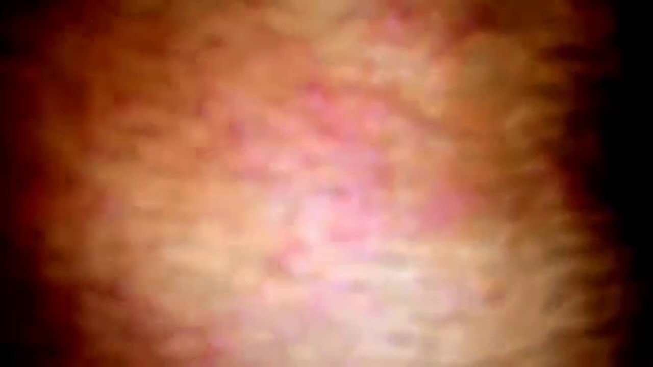 Herpes zoster cyst surgery in skin