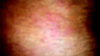 Herpes zoster