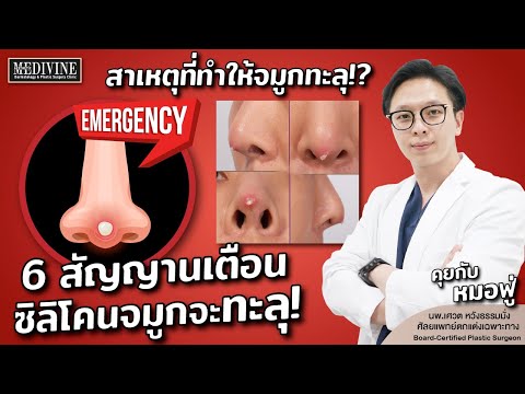 6 สัญญาณเตือน ซิลิโคนจมูกใกล้ทะลุ!! ปลายจมูกบาง จมูกแดง ต้องรีบแก้จมูกด่วน! สาเหตุที่ทำให้จมูกทะลุ??