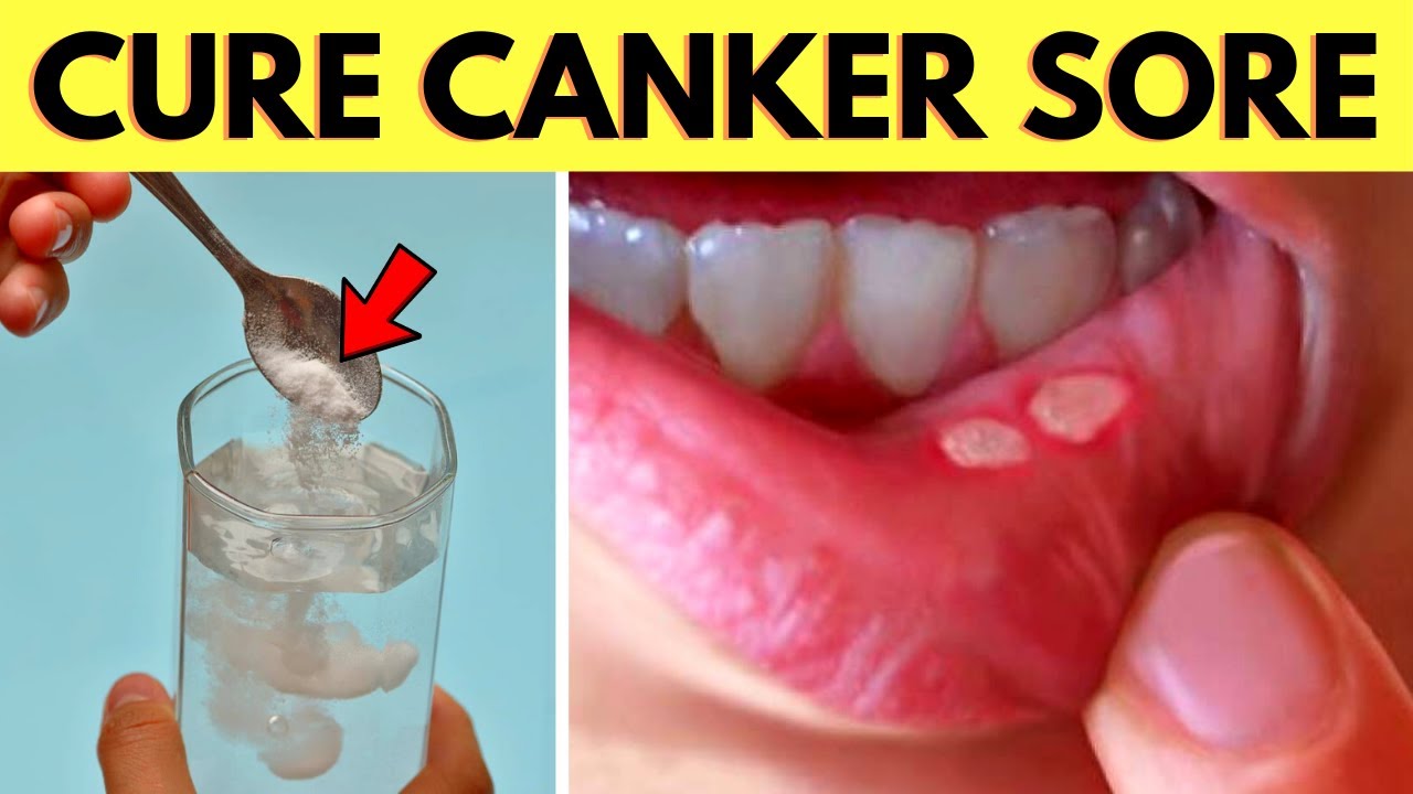 Get rid of a canker sore on gums, lip, tongue and roof of mouth in 24