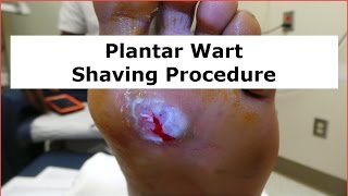 Plantar Wart Shaving Procedure