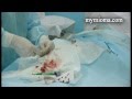 Эмболизация маточных артерий в Запорожье видео