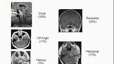 Come funziona la Gamma Knife?