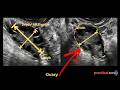 How to: Measure Ovary Volume on Ultrasound