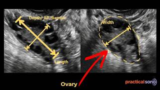 Ovary Measurement Ultrasound (DEMO)