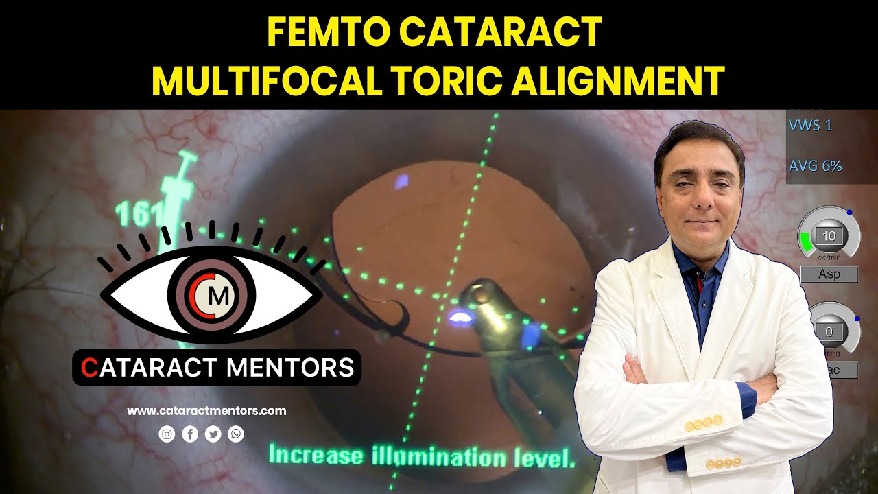 Femto Cataract Multifocal Toric Alignment - YouTube