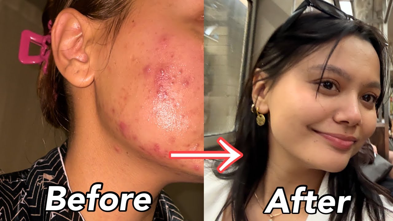 How I Got Rid of My Acne | Products that changed my life ! NOT ...
