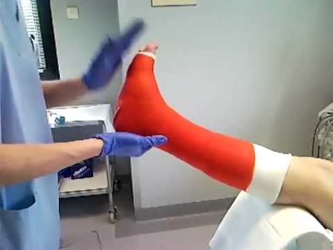 Confezionamento di gambaletto gessato a contatto totale - YouTube