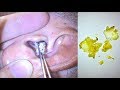 How to eliminate earwax #4