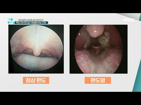 [기분 좋은 날] 목감기와 편도염 구분해야 하는 이유 20200522