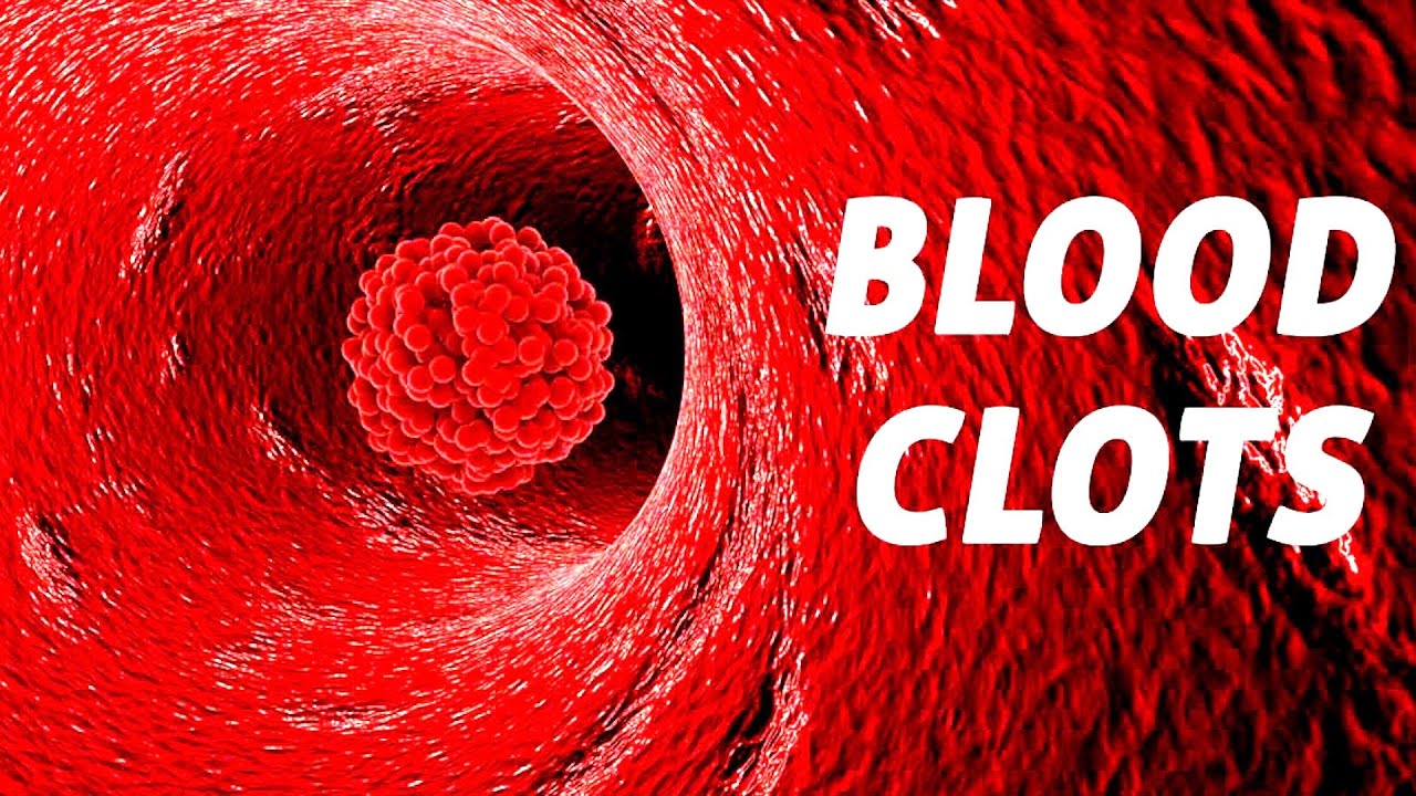 4 Signs You Have a Blood Clot In Your Body!! YouTube