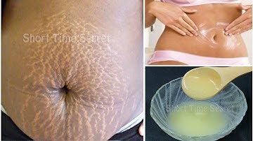 In 3 Days Remove Stretch Marks Completely | World