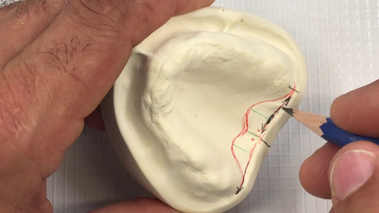 1d) Posterior Palatal Seal