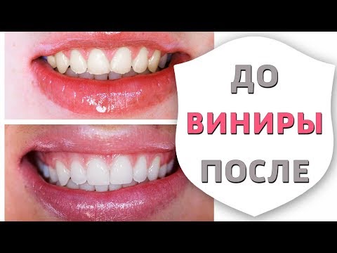 Голливудская улыбка: 5 зубных щеток, которые помогут сэкономить на стоматологе
