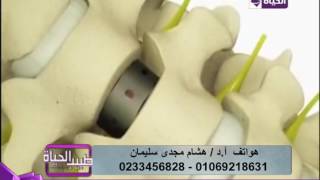 طبيب الحياة - أ.د/ هشام مجدي - فيديو يوضح تركيب الدعامة لعلاج الإنزلاق الغضروفي في الفقرات العنقية