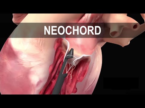 NEOCHORD | Kalp Çalışırken Yapılan Kalp Kapağı Tamiri