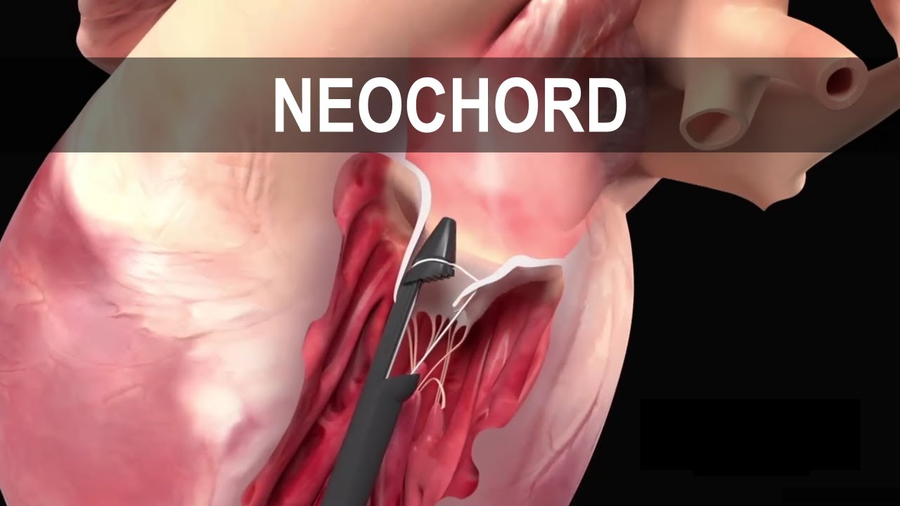 NeoChord Yöntemi 2 NeoChord Yöntemi