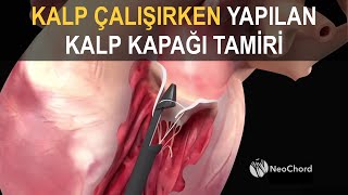 Neochord Kalp Çalışırken Yapılan Kalp Kapağı Tamiri