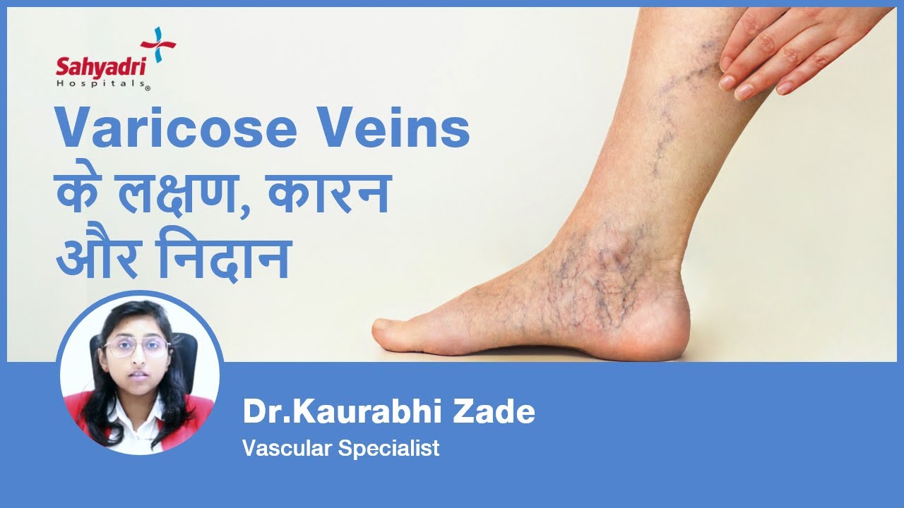 Varicose veins: Symptoms, Causes, Diagnosis, and Treatment