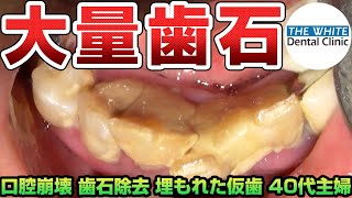 大量歯石[口腔崩壊|歯石除去|埋もれた仮歯|40代主婦]tartar removal牙垢