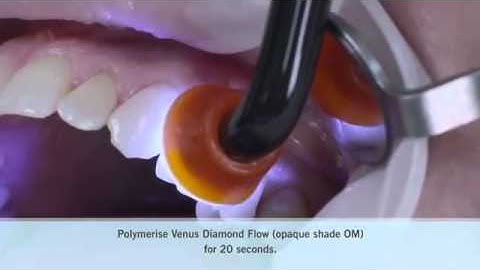 Perfect class V restorations   flow or conventional composite EN