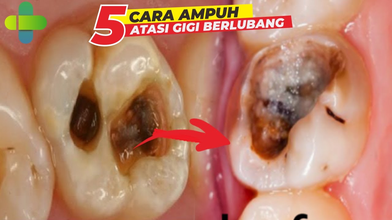 5 CARA ATASI SAKIT GIGI BERLUBANG PALING AMPUH DAN TIDAK KAMBUH LAGI ll