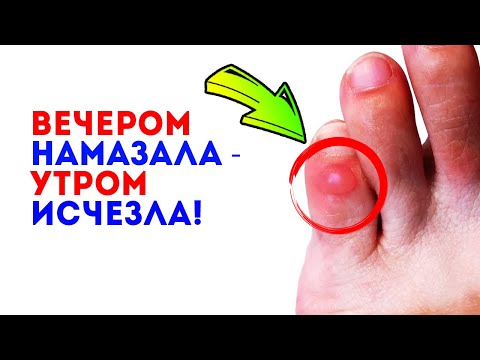 Больше не хромаю! Узнала проверенное средство от мозолей