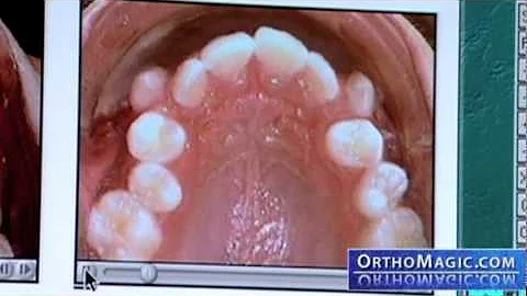 Temporary Anchorage Devices -- Orthodontics in Detroit, MI