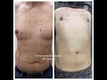 Gyno surgery in Pakistan with liposuction