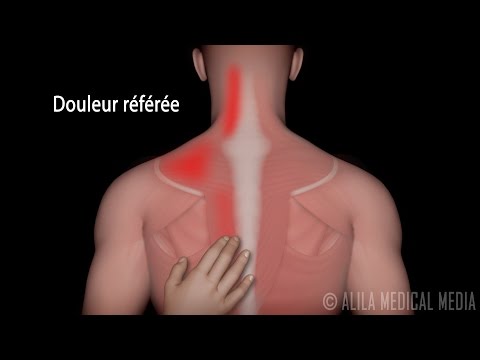 Vidéo: Douleur Dans Le Haut Du Dos Gauche: Causes, Diagnostic, Remèdes Et Traitement