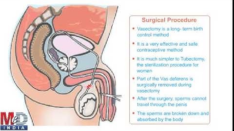 Vasectomy
