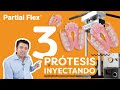 Dr. Cabrera utiliza PARTIAL FLEX con tres prótesis ¡SIN FALLAS!