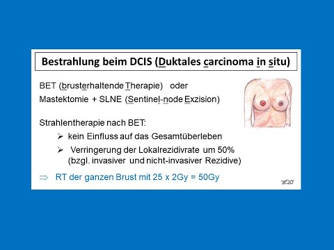 Video: Was ist schlimmer Duktal- oder Läppchenkrebs?