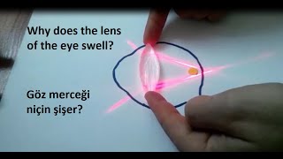 why does the lens of the eye swell? -- Göz merceği niçin şişer?
