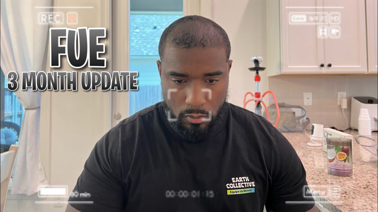 3 MONTH FUE HAIR TRANSPLANT UPDATE | AFRICAN AMERICAN